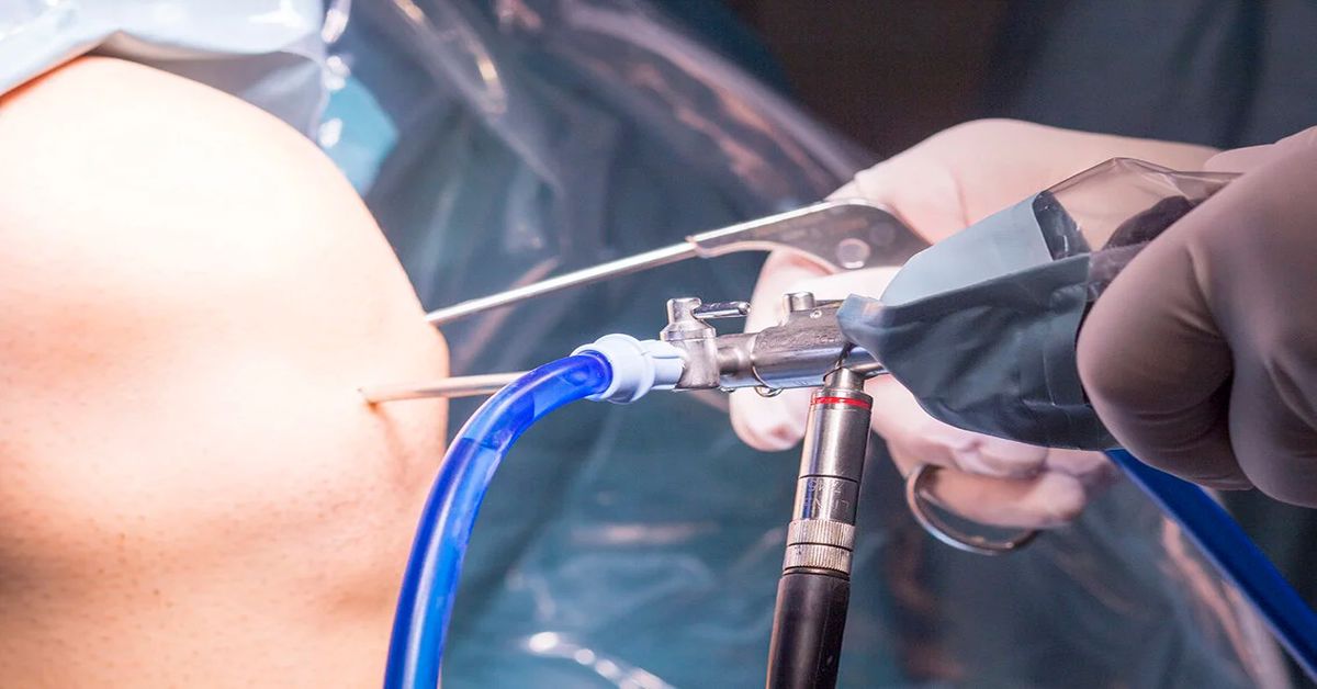 Artroskopi Ameliyatı Nedir?