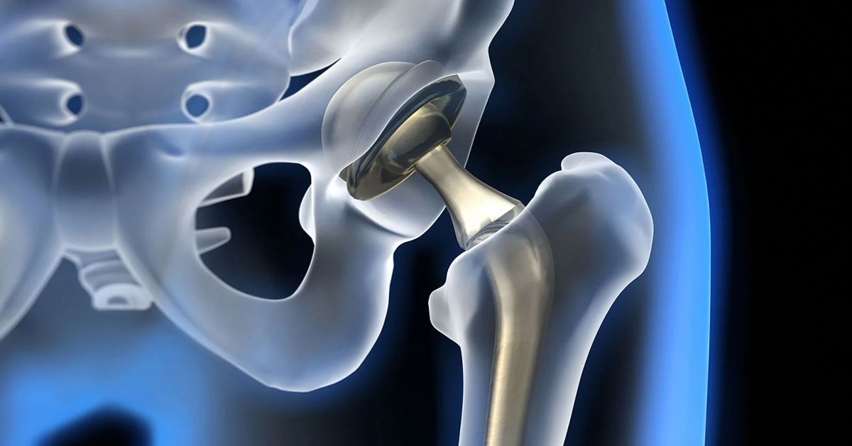 Kalça Protezi Ameliyatı