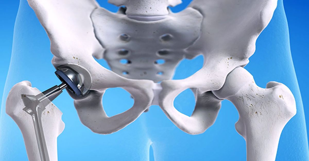 Kalça Protezi Ameliyatı