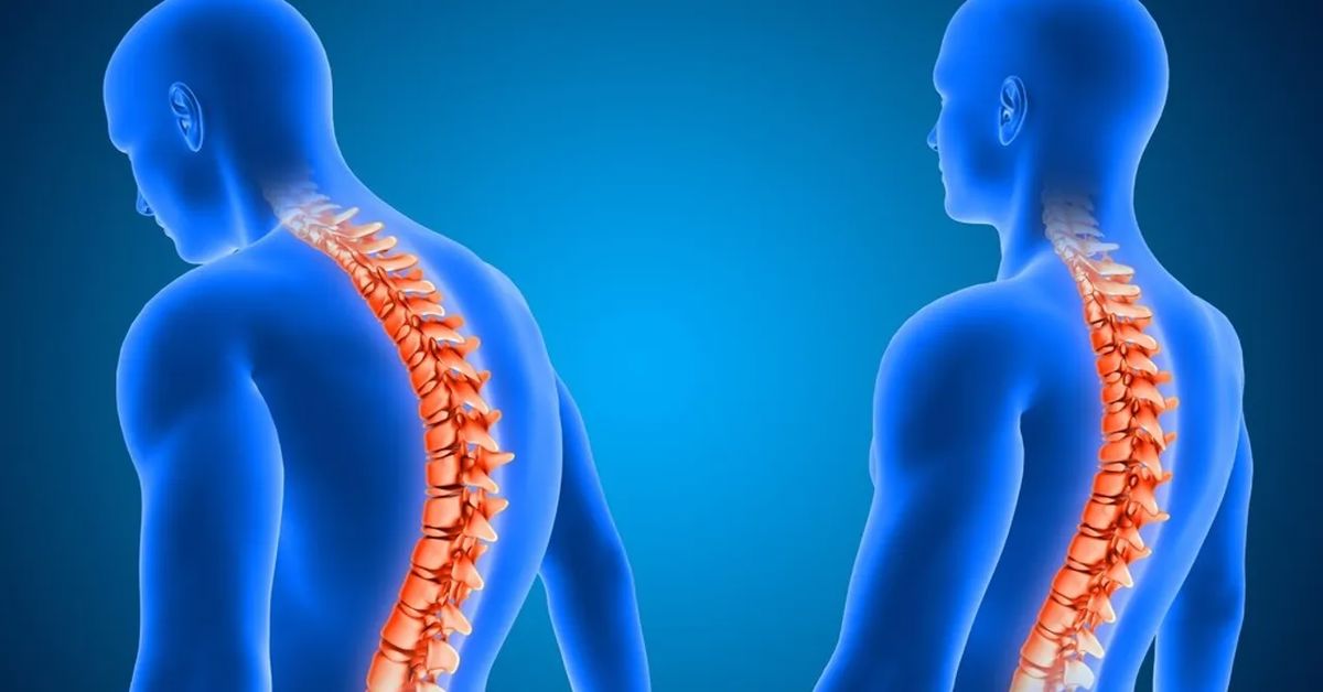 Omurga Kireçlenmesi