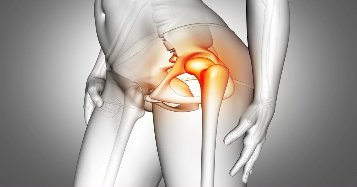 Kalça Kırığı Tedavisi