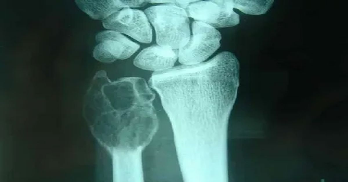 Kemik Tümörü Nedir?