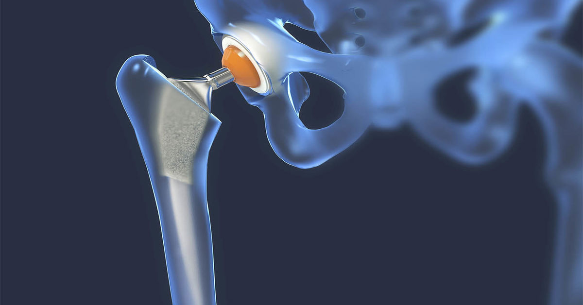 Kalça Protezi Nedir?